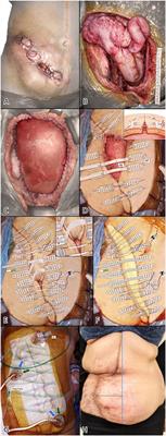 Case Report: Delayed Primary Wound Closure After Extensive Abdominal Wall Resection for Infection and Malignancy Using TopClosure®